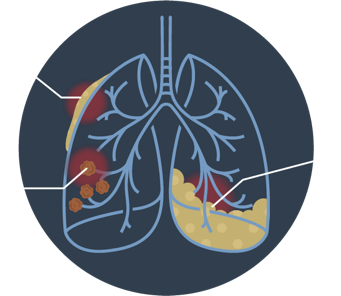 Health Effects of Asbestos